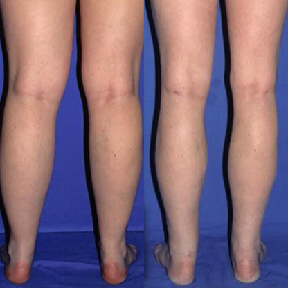 Lymphoa's Lymphdrainage-Formel